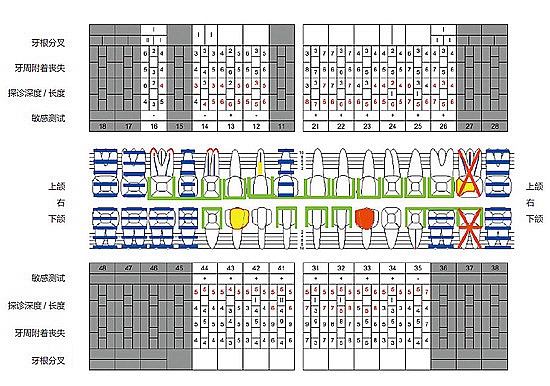 多學(xué)科聯(lián)合種植修復(fù)治療罹患廣泛性重度慢性牙周炎病例(I) 多學(xué)科聯(lián)合種植修復(fù)治療罹患廣泛性重度慢性牙周炎病例(I)
