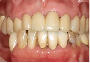 多學(xué)科聯(lián)合種植修復(fù)治療罹患廣泛性重度慢性牙周炎病例(I) 多學(xué)科聯(lián)合種植修復(fù)治療罹患廣泛性重度慢性牙周炎病例(I)