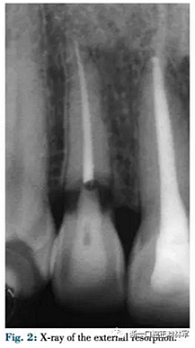 文獻優(yōu)秀正畸病例賞析--正畸牙周聯(lián)合治療方法病例介紹 文獻優(yōu)秀正畸病例賞析--正畸牙周聯(lián)合治療方法病例介紹