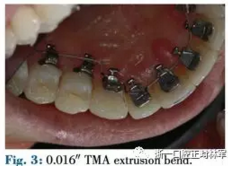 文獻優(yōu)秀正畸病例賞析--正畸牙周聯(lián)合治療方法病例介紹 文獻優(yōu)秀正畸病例賞析--正畸牙周聯(lián)合治療方法病例介紹