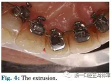 文獻優(yōu)秀正畸病例賞析--正畸牙周聯(lián)合治療方法病例介紹 文獻優(yōu)秀正畸病例賞析--正畸牙周聯(lián)合治療方法病例介紹