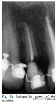 文獻優(yōu)秀正畸病例賞析--正畸牙周聯(lián)合治療方法病例介紹 文獻優(yōu)秀正畸病例賞析--正畸牙周聯(lián)合治療方法病例介紹