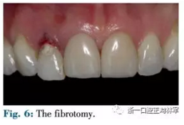 文獻優(yōu)秀正畸病例賞析--正畸牙周聯(lián)合治療方法病例介紹 文獻優(yōu)秀正畸病例賞析--正畸牙周聯(lián)合治療方法病例介紹