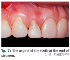 文獻優(yōu)秀正畸病例賞析--正畸牙周聯(lián)合治療方法病例介紹 文獻優(yōu)秀正畸病例賞析--正畸牙周聯(lián)合治療方法病例介紹