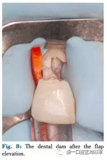 文獻優(yōu)秀正畸病例賞析--正畸牙周聯(lián)合治療方法病例介紹 文獻優(yōu)秀正畸病例賞析--正畸牙周聯(lián)合治療方法病例介紹