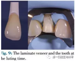 文獻優(yōu)秀正畸病例賞析--正畸牙周聯(lián)合治療方法病例介紹 文獻優(yōu)秀正畸病例賞析--正畸牙周聯(lián)合治療方法病例介紹