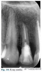 文獻優(yōu)秀正畸病例賞析--正畸牙周聯(lián)合治療方法病例介紹 文獻優(yōu)秀正畸病例賞析--正畸牙周聯(lián)合治療方法病例介紹