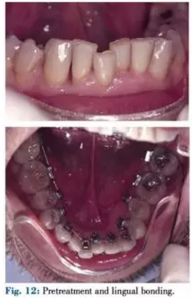 文獻優(yōu)秀正畸病例賞析--正畸牙周聯(lián)合治療方法病例介紹 文獻優(yōu)秀正畸病例賞析--正畸牙周聯(lián)合治療方法病例介紹