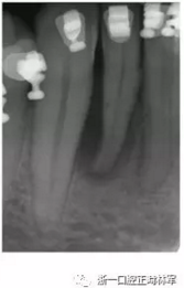 文獻優(yōu)秀正畸病例賞析--正畸牙周聯(lián)合治療方法病例介紹 文獻優(yōu)秀正畸病例賞析--正畸牙周聯(lián)合治療方法病例介紹