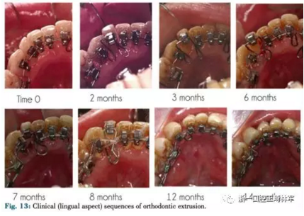 文獻優(yōu)秀正畸病例賞析--正畸牙周聯(lián)合治療方法病例介紹 文獻優(yōu)秀正畸病例賞析--正畸牙周聯(lián)合治療方法病例介紹