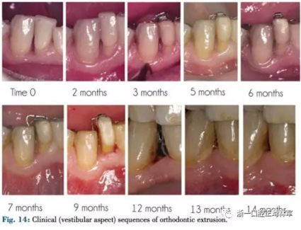 文獻優(yōu)秀正畸病例賞析--正畸牙周聯(lián)合治療方法病例介紹 文獻優(yōu)秀正畸病例賞析--正畸牙周聯(lián)合治療方法病例介紹