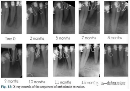 文獻優(yōu)秀正畸病例賞析--正畸牙周聯(lián)合治療方法病例介紹 文獻優(yōu)秀正畸病例賞析--正畸牙周聯(lián)合治療方法病例介紹
