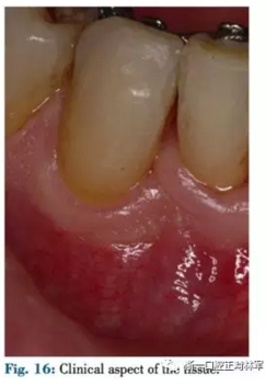 文獻優(yōu)秀正畸病例賞析--正畸牙周聯(lián)合治療方法病例介紹 文獻優(yōu)秀正畸病例賞析--正畸牙周聯(lián)合治療方法病例介紹