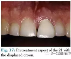 文獻優(yōu)秀正畸病例賞析--正畸牙周聯(lián)合治療方法病例介紹 文獻優(yōu)秀正畸病例賞析--正畸牙周聯(lián)合治療方法病例介紹