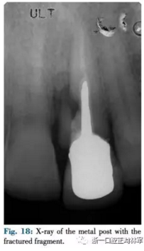 文獻優(yōu)秀正畸病例賞析--正畸牙周聯(lián)合治療方法病例介紹 文獻優(yōu)秀正畸病例賞析--正畸牙周聯(lián)合治療方法病例介紹