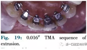 文獻優(yōu)秀正畸病例賞析--正畸牙周聯(lián)合治療方法病例介紹 文獻優(yōu)秀正畸病例賞析--正畸牙周聯(lián)合治療方法病例介紹