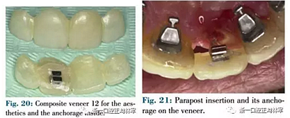 文獻優(yōu)秀正畸病例賞析--正畸牙周聯(lián)合治療方法病例介紹 文獻優(yōu)秀正畸病例賞析--正畸牙周聯(lián)合治療方法病例介紹