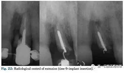 文獻優(yōu)秀正畸病例賞析--正畸牙周聯(lián)合治療方法病例介紹 文獻優(yōu)秀正畸病例賞析--正畸牙周聯(lián)合治療方法病例介紹