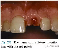 文獻優(yōu)秀正畸病例賞析--正畸牙周聯(lián)合治療方法病例介紹 文獻優(yōu)秀正畸病例賞析--正畸牙周聯(lián)合治療方法病例介紹