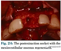 文獻優(yōu)秀正畸病例賞析--正畸牙周聯(lián)合治療方法病例介紹 文獻優(yōu)秀正畸病例賞析--正畸牙周聯(lián)合治療方法病例介紹