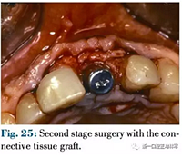 文獻優(yōu)秀正畸病例賞析--正畸牙周聯(lián)合治療方法病例介紹 文獻優(yōu)秀正畸病例賞析--正畸牙周聯(lián)合治療方法病例介紹