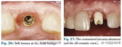 文獻優(yōu)秀正畸病例賞析--正畸牙周聯(lián)合治療方法病例介紹 文獻優(yōu)秀正畸病例賞析--正畸牙周聯(lián)合治療方法病例介紹