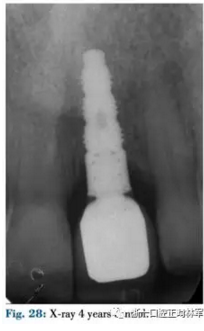 文獻優(yōu)秀正畸病例賞析--正畸牙周聯(lián)合治療方法病例介紹 文獻優(yōu)秀正畸病例賞析--正畸牙周聯(lián)合治療方法病例介紹