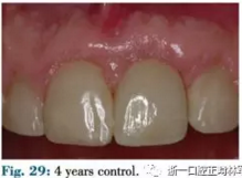 文獻優(yōu)秀正畸病例賞析--正畸牙周聯(lián)合治療方法病例介紹 文獻優(yōu)秀正畸病例賞析--正畸牙周聯(lián)合治療方法病例介紹