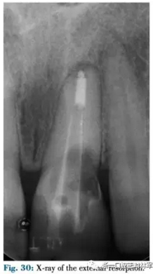 文獻優(yōu)秀正畸病例賞析--正畸牙周聯(lián)合治療方法病例介紹 文獻優(yōu)秀正畸病例賞析--正畸牙周聯(lián)合治療方法病例介紹