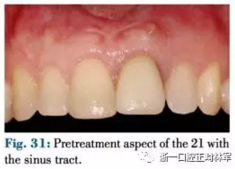 文獻優(yōu)秀正畸病例賞析--正畸牙周聯(lián)合治療方法病例介紹 文獻優(yōu)秀正畸病例賞析--正畸牙周聯(lián)合治療方法病例介紹