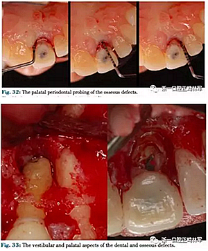 文獻優(yōu)秀正畸病例賞析--正畸牙周聯(lián)合治療方法病例介紹 文獻優(yōu)秀正畸病例賞析--正畸牙周聯(lián)合治療方法病例介紹