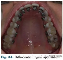 文獻優(yōu)秀正畸病例賞析--正畸牙周聯(lián)合治療方法病例介紹 文獻優(yōu)秀正畸病例賞析--正畸牙周聯(lián)合治療方法病例介紹