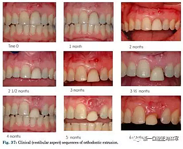 文獻優(yōu)秀正畸病例賞析--正畸牙周聯(lián)合治療方法病例介紹 文獻優(yōu)秀正畸病例賞析--正畸牙周聯(lián)合治療方法病例介紹