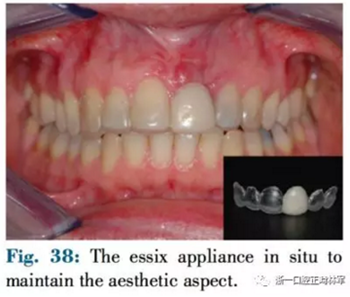 文獻優(yōu)秀正畸病例賞析--正畸牙周聯(lián)合治療方法病例介紹 文獻優(yōu)秀正畸病例賞析--正畸牙周聯(lián)合治療方法病例介紹