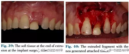 文獻優(yōu)秀正畸病例賞析--正畸牙周聯(lián)合治療方法病例介紹 文獻優(yōu)秀正畸病例賞析--正畸牙周聯(lián)合治療方法病例介紹