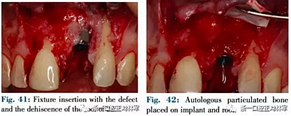文獻優(yōu)秀正畸病例賞析--正畸牙周聯(lián)合治療方法病例介紹 文獻優(yōu)秀正畸病例賞析--正畸牙周聯(lián)合治療方法病例介紹