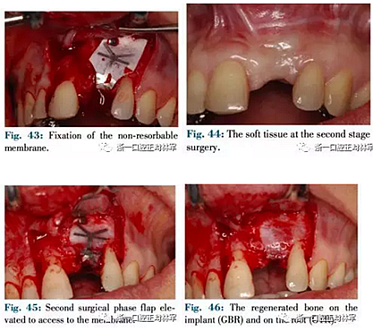 文獻優(yōu)秀正畸病例賞析--正畸牙周聯(lián)合治療方法病例介紹 文獻優(yōu)秀正畸病例賞析--正畸牙周聯(lián)合治療方法病例介紹