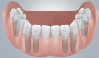 無牙頜種植修復(fù)的檢查與設(shè)計&mdash;&mdash;施斌教授
