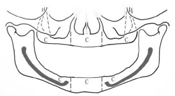 無牙頜種植修復(fù)的檢查與設(shè)計&mdash;&mdash;施斌教授