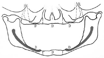 無牙頜種植修復(fù)的檢查與設(shè)計&mdash;&mdash;施斌教授