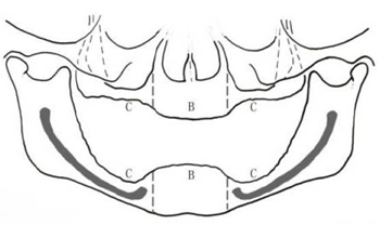 無牙頜種植修復(fù)的檢查與設(shè)計&mdash;&mdash;施斌教授