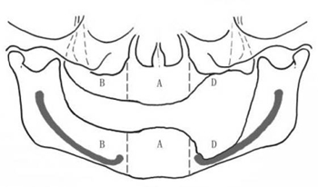 無牙頜種植修復(fù)的檢查與設(shè)計&mdash;&mdash;施斌教授