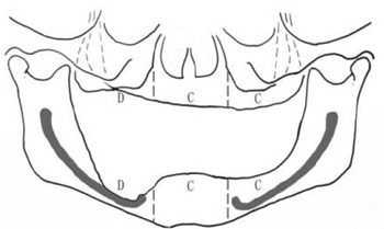 無牙頜種植修復(fù)的檢查與設(shè)計&mdash;&mdash;施斌教授