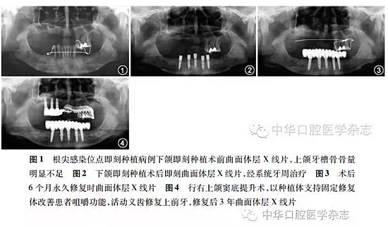 【專家筆談】即刻種植治療方案的評估與實施 【專家筆談】即刻種植治療方案的評估與實施