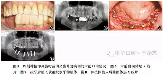 【專家筆談】即刻種植治療方案的評估與實施 【專家筆談】即刻種植治療方案的評估與實施