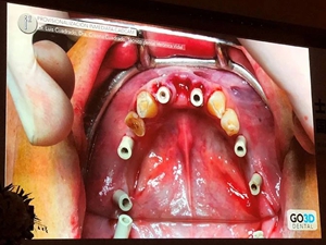 課堂筆記 | 看大師如何運(yùn)用數(shù)字化流程解決復(fù)雜病例 課堂筆記 | 看大師如何運(yùn)用數(shù)字化流程解決復(fù)雜病例