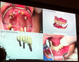 課堂筆記 | 看大師如何運(yùn)用數(shù)字化流程解決復(fù)雜病例 課堂筆記 | 看大師如何運(yùn)用數(shù)字化流程解決復(fù)雜病例