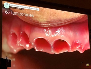 課堂筆記 | 看大師如何運(yùn)用數(shù)字化流程解決復(fù)雜病例 課堂筆記 | 看大師如何運(yùn)用數(shù)字化流程解決復(fù)雜病例
