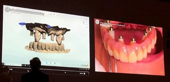 課堂筆記 | 看大師如何運(yùn)用數(shù)字化流程解決復(fù)雜病例 課堂筆記 | 看大師如何運(yùn)用數(shù)字化流程解決復(fù)雜病例