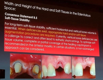 課堂筆記 | 看大師如何運(yùn)用數(shù)字化流程解決復(fù)雜病例 課堂筆記 | 看大師如何運(yùn)用數(shù)字化流程解決復(fù)雜病例